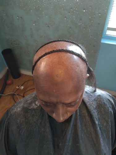 Customer photo review of Alopecia Growth Serum