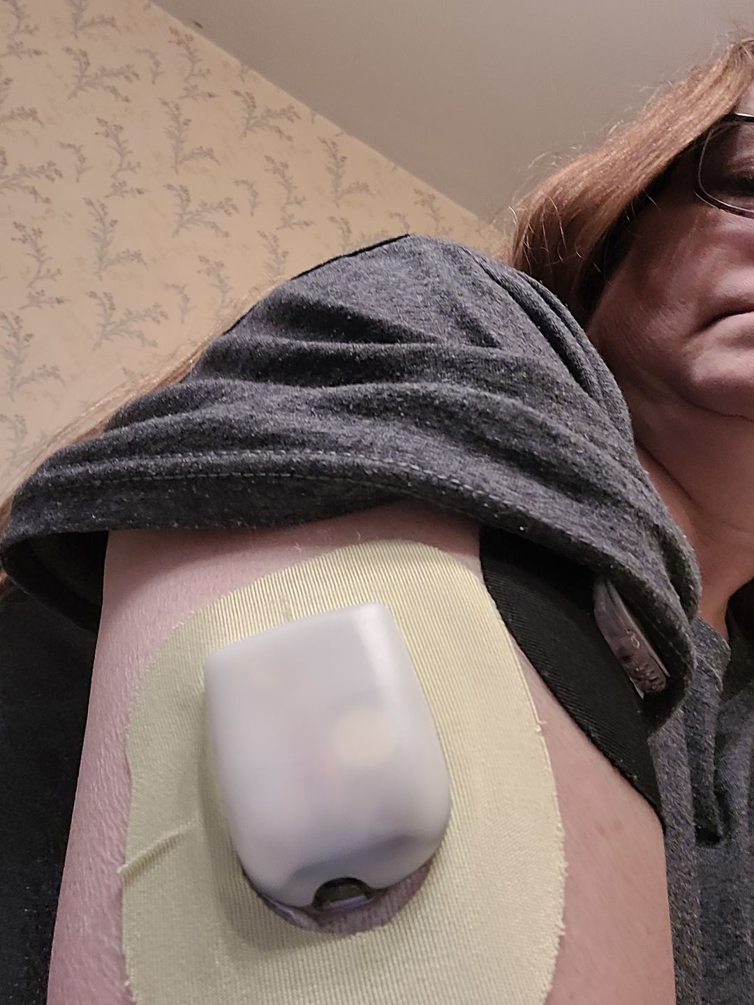 Customer photo review of Skin Grip Original - Omnipod Adhesive Patches