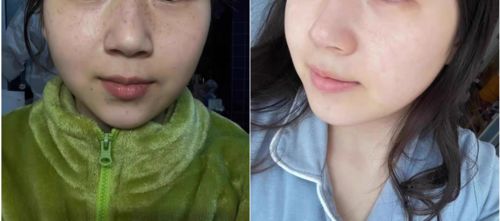 Customer photo review of GloWhite™ Dark-Spot Corrector Cream（🔥Limited time discount）