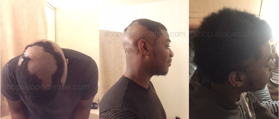 Customer photo review of The Scalp System
