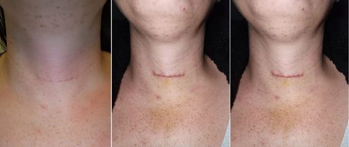 Customer photo review of ScarAway® Advanced Scar Gel（Limited time discount 🔥 last day）