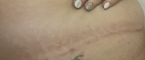 Customer photo review of ScarAway® Advanced Scar Gel（Limited time discount 🔥 last day）