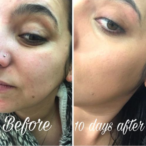 Customer photo review of Turmeric Dark Spot Corrector Serum（Limited time discount 🔥 last day）