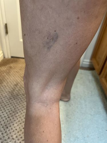 Customer photo review of MEDix™ Varicose Veins Spray（Limited time discount 🔥 last day）