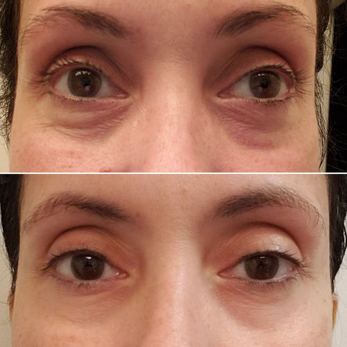Customer photo review of ForeverUng™ Anti-Aging Koffein Ögonserum