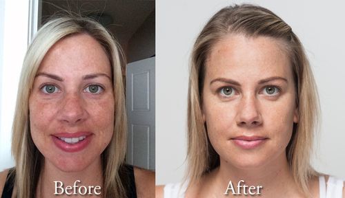 Customer photo review of Turmeric Dark Spot Corrector Serum（Limited time discount 🔥 last day）