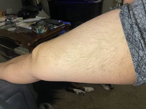 Customer photo review of MEDix™ Varicose Veins Spray（Limited time discount 🔥 last day）