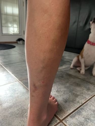 Customer photo review of MEDix™ Varicose Veins Spray（Limited time discount 🔥 last day）