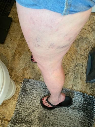 Customer photo review of MEDix™ Varicose Veins Spray（Limited time discount 🔥 last day）