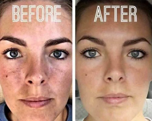 Customer photo review of Turmeric Dark Spot Corrector Serum（Limited time discount 🔥 last day）
