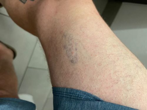 Customer photo review of MEDix™ Varicose Veins Spray（Limited time discount 🔥 last day）