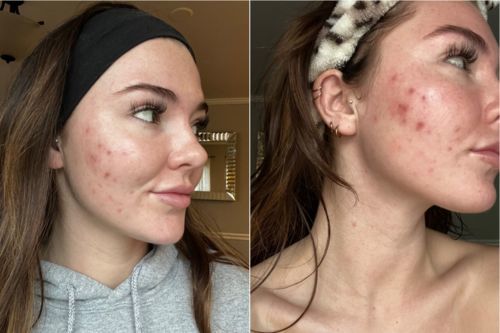 Customer photo review of ScarAway® Advanced Scar Gel（Limited time discount 🔥 last day）