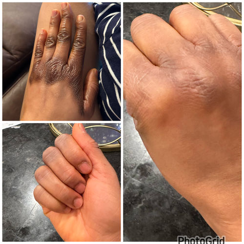 Customer photo review of Extreme Dark Hands Feet Knees And Elbows Repair Cream