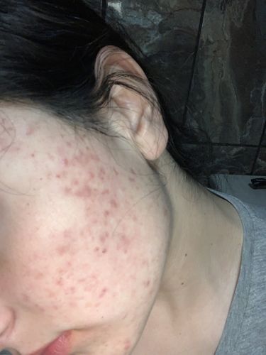 Customer photo review of Kit anti acné