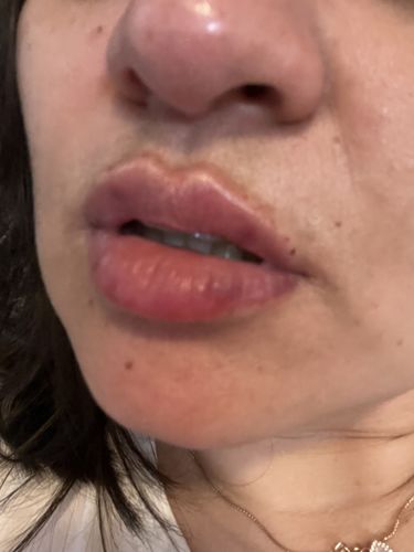 Customer photo review of LipFix: Filler