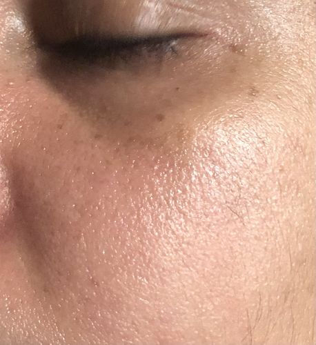 Customer photo review of Niacinamide 10% + Zinc 1% - Super Activs Skin Serum