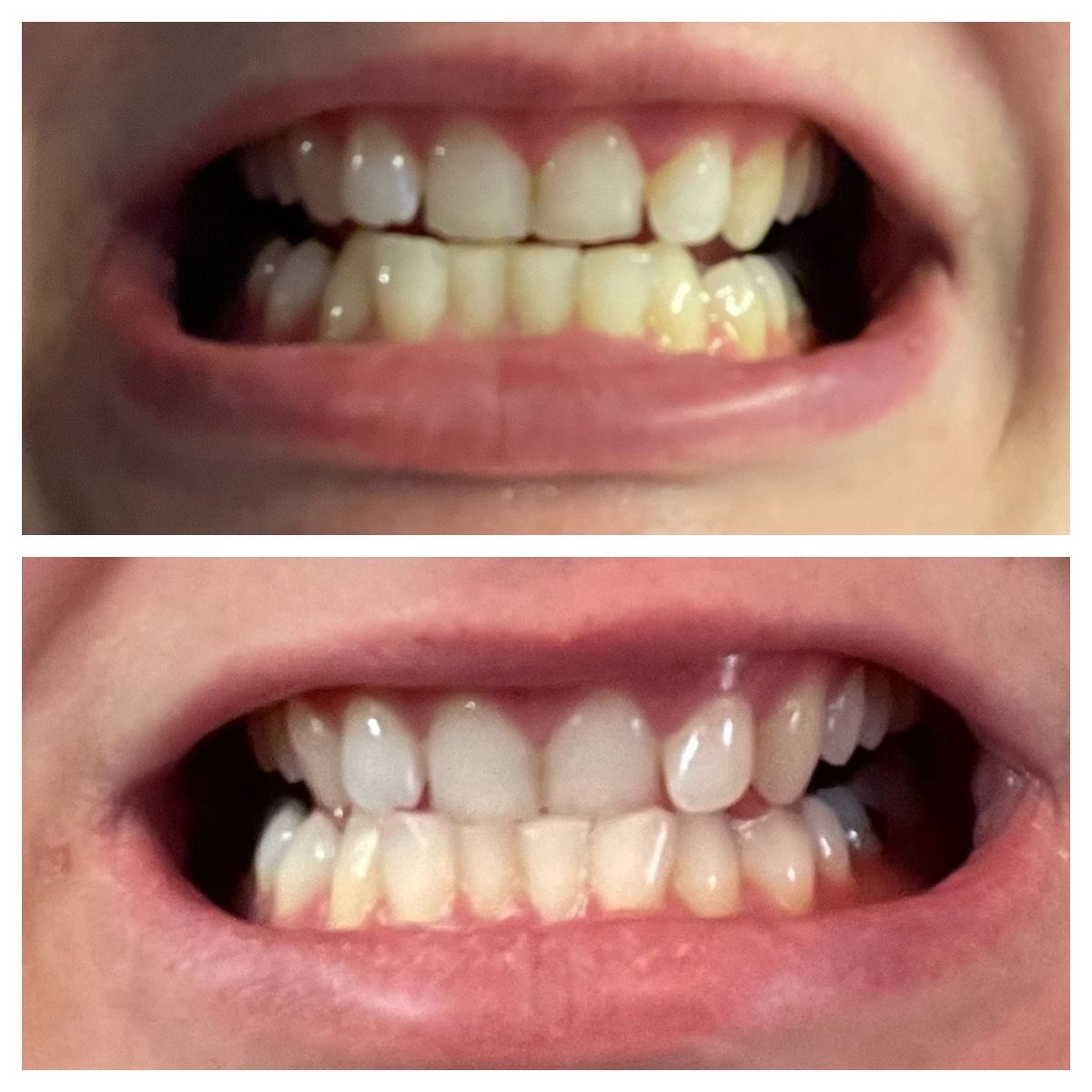 Customer photo review of Bandes Blanchissantes PAP (sans peroxyde)