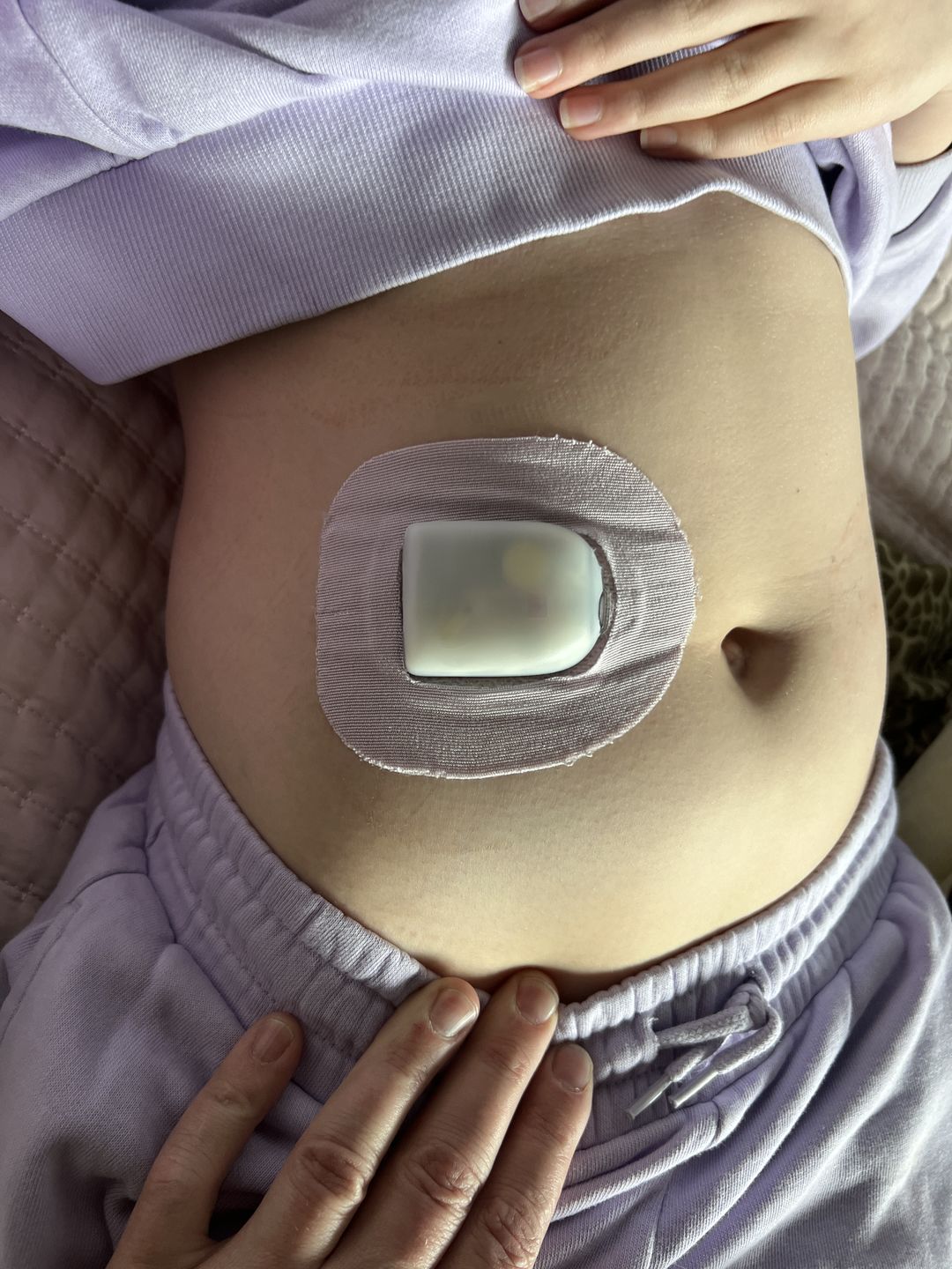 Customer photo review of Skin Grip Original - Omnipod Adhesive Patches