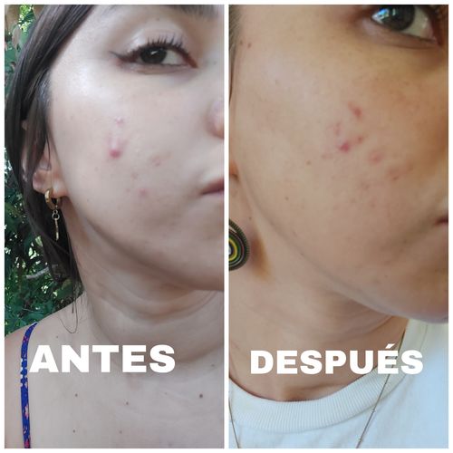 Customer photo review of AHA-BHA-PHA 30 Days Miracle Acne Clear Foam - 100ml