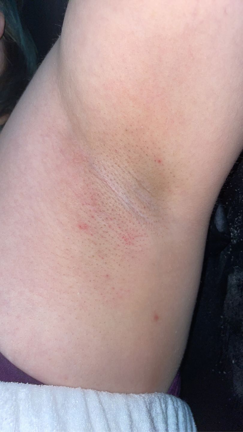 Customer photo review of Hypoallergenic Tea Tree Oil Soft Wax