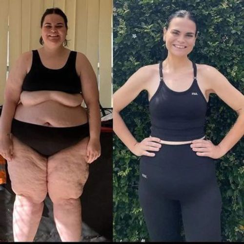 Customer photo review of Perfect Detox Slimming Patch(Limited Time Discount 🔥 Last Day)