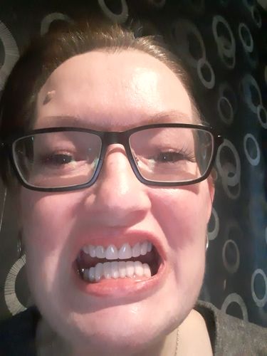 Customer photo review of Teeth-Veneer 2.0
