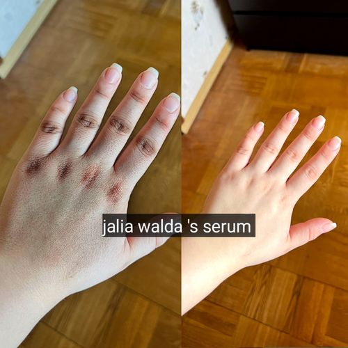Customer photo review of Knuckle serum (removes dark knuckles)