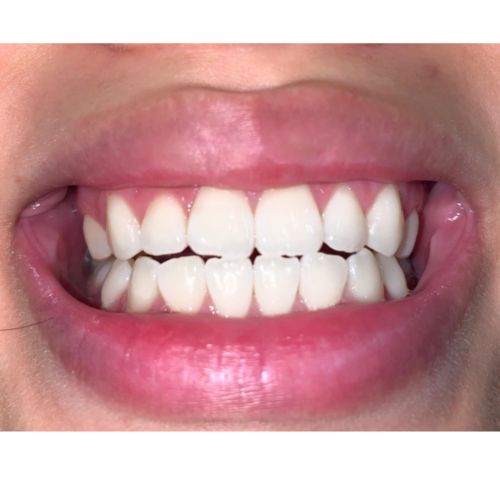 Customer photo review of Polar MD Teeth Whitening Kit