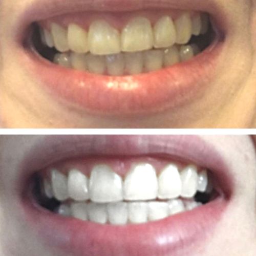 Customer photo review of Polar MD Teeth Whitening Kit