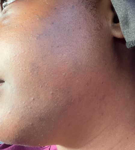 Customer photo review of BERRI-CLEAR+ 5 BERRY SUPERFRUIT SERUM