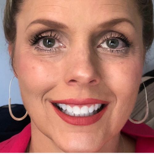 Customer photo review of Polar MD Teeth Whitening Kit