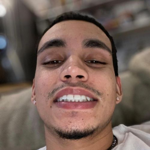 Customer photo review of Polar MD Teeth Whitening Kit