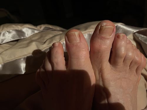 Customer photo review of Onychom - Antifungal Laser Device