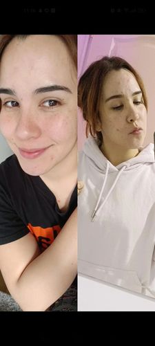 Customer photo review of Kit anti acné