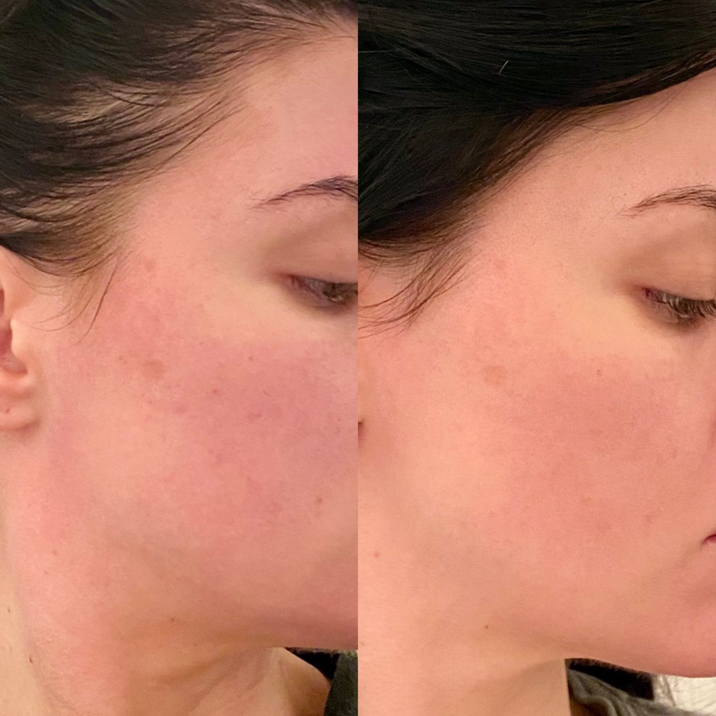 Customer photo review of 14% Jessner Skin Peel 🌿🍃🌱 Everything you need to do a skin peel! 🤩