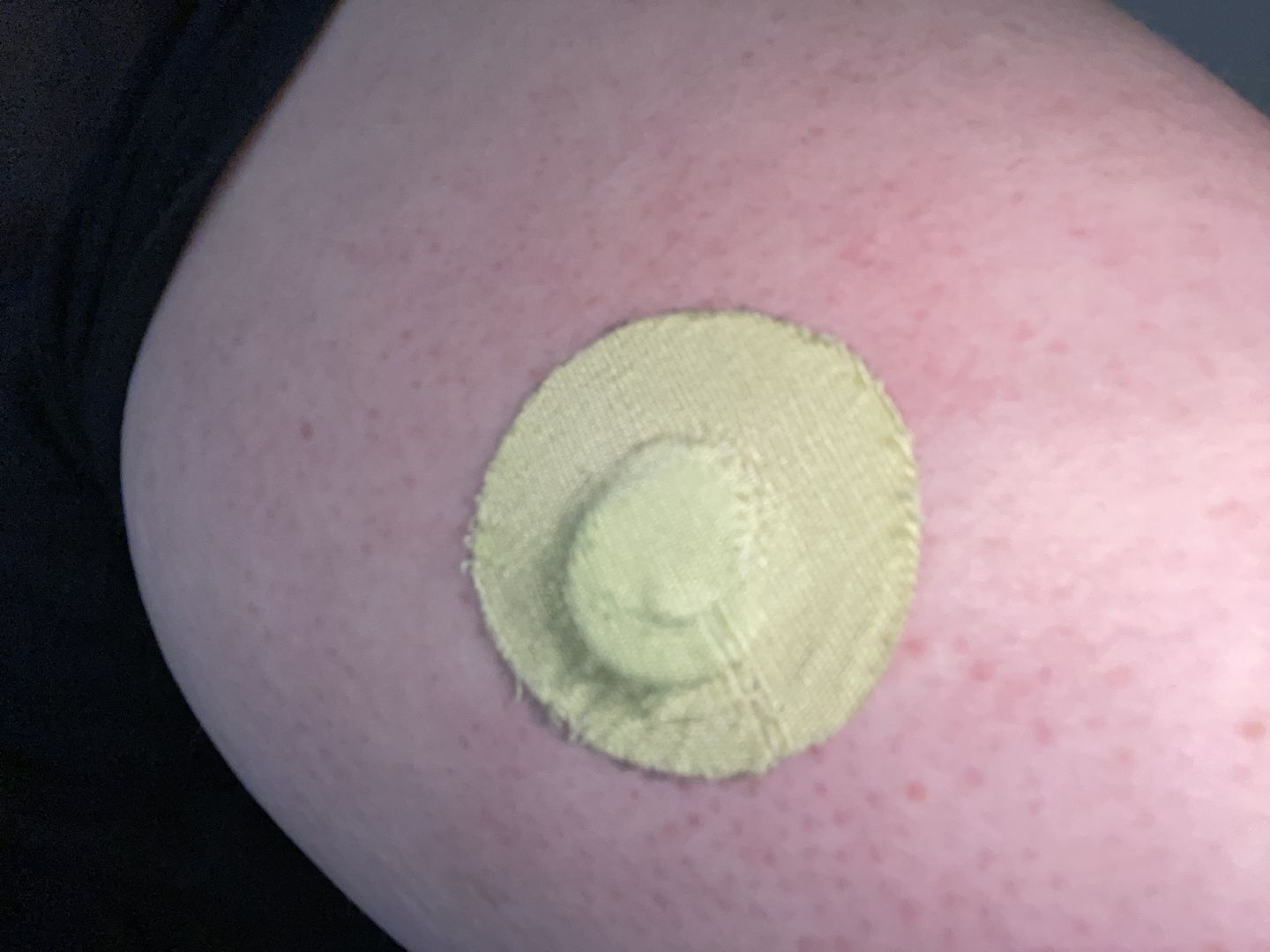 Customer photo review of Skin Grip Original - Freestyle Libre 3 Adhesive Patches