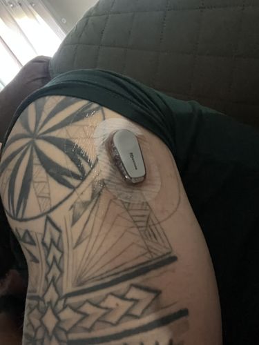 Customer photo review of Skin Grip Original - Dexcom G6 Patches