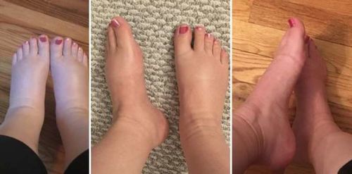 Customer photo review of MediGinger AntiSwelling LympUnclog Ointment(Limited Time Discount 🔥 Last Day)