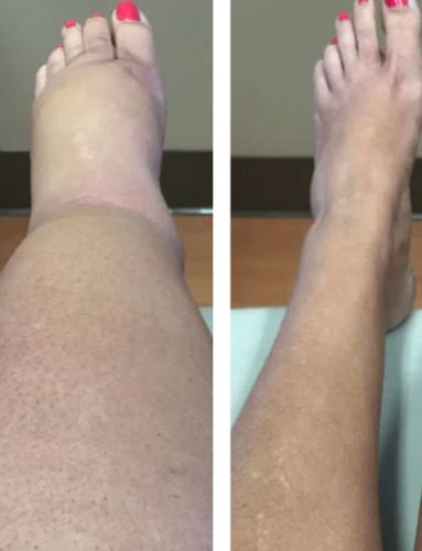 Customer photo review of MediGinger AntiSwelling LympUnclog Ointment(Limited Time Discount 🔥 Last Day)