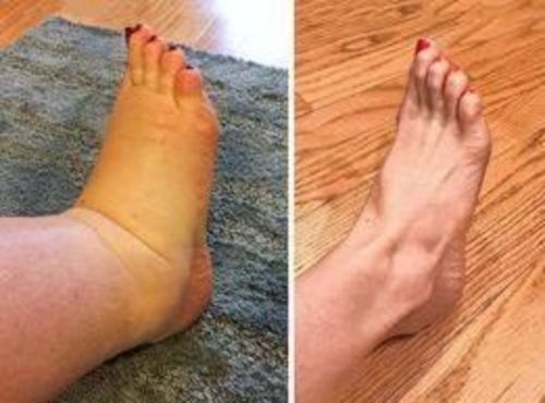 Customer photo review of MediGinger AntiSwelling LympUnclog Ointment(Limited Time Discount 🔥 Last Day)