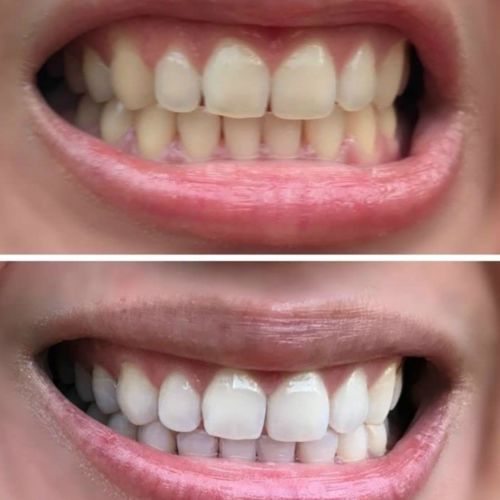 Customer photo review of Gleam Ultimate Bundle