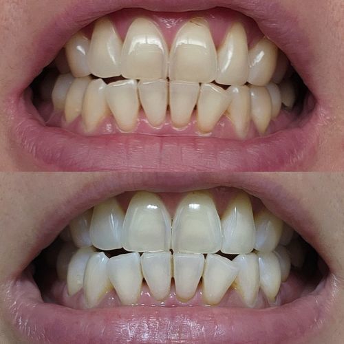 Customer photo review of Teeth Whitening Kit