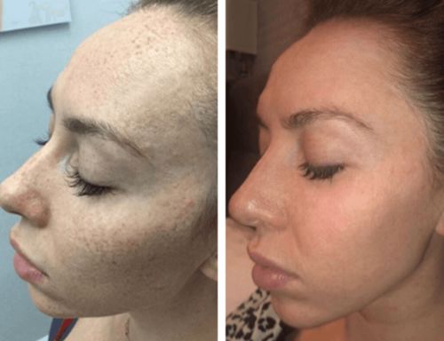 Customer photo review of HudElixir™ #1 Serum För Anti-Rynk Och Mörka Fläckar