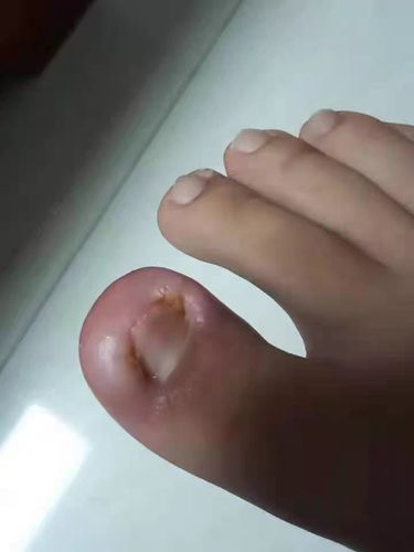 Customer photo review of German ToenailPlus™ Anti Paronychia Relief Oil