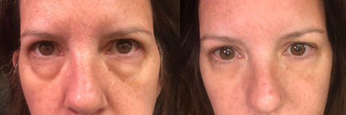 Customer photo review of Beautology™ Peptid Ögonlyftsgel