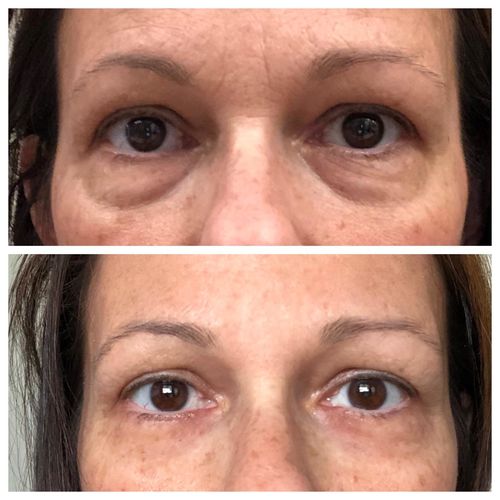 Customer photo review of Beautology™ Peptid Ögonlyftsgel