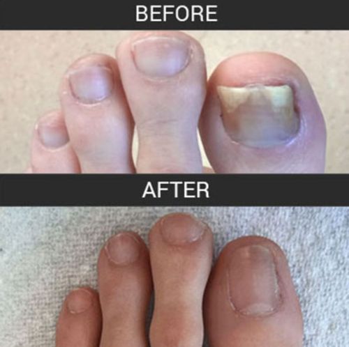 Customer photo review of German ToenailPlus™ Anti Paronychia Relief Oil
