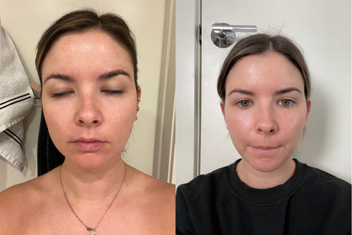 Customer photo review of HudElixir™ #1 Serum För Anti-Rynk Och Mörka Fläckar
