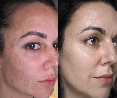 Customer photo review of HudElixir™ #1 Serum För Anti-Rynk Och Mörka Fläckar