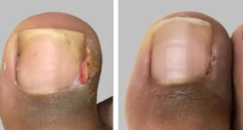 Customer photo review of German ToenailPlus™ Anti Paronychia Relief Oil